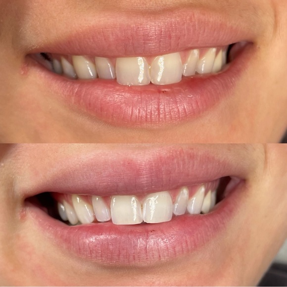 TEETH WHITENING KIT - Picture 4 of 4